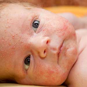 Dấu hiệu và cách phòng bệnh sốt xuất huyết ở trẻ